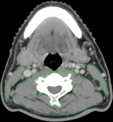 Low Skeletal Muscle Mass Impairs Quality of Life in Nasopharyngeal Carcinoma Patients Treated With Concurrent Chemoradiotherapy